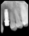 Figure 8 Radiograph of the right maxillary implant, im- mediately after placement.