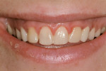 Figure 10 Provisional crowns immediately after placement.