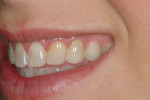 Figure 13 The definitive restorations, 3 months after placement.