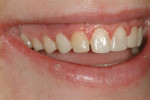 Figure 14 The definitive restorations, 3 months after placement.