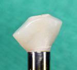 Figure 12 The custom healing two-piece abutment with voids filled in with acrylic resin, fully contoured and polished prior to insertion; while in place, healing was allowed to occur for 6 months before first disconnection.
