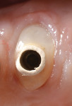 Figure 17 Clinical appearance of the gingival tissues around the custom healing abutment 8 months post-surgical healing.