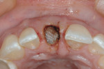 Figure 3 Ridge preservation using a mineralized allograft and bioresorbable membrane, performed without reflection of a mucoperiosteal flap.