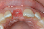 Figure 8 The buccal-palatal width was maintained with a proper grafted site, and ovate pontic created for the provisional.