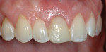 Figure 6 Healing 3 weeks after the tooth was extracted.