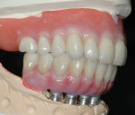 Figure 22 Lateral view of upper final denture opposing final zirconia bridge.