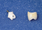 Figure1 Zirconiaabutmentandall-ceramiccrown.Becausedu- plicate abutments were created, the crown will fit both the origi- nal titanium abutment and the replacement zirconia abutment.