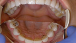 Static and dynamic occlusal adjustment.