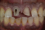 Final milled zirconia abutment placed on implant and veneer preparation for No. 9.