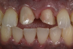 A wash bake of dentine was added onto the zirconia coping to match the stump shade of the prepped veneer of tooth No. 9.