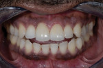 Post-treatment clinical frontal retracted view showing an excellent porcelain match on Nos. 8 and 9. Note the perfect matching between the final restorations and the natural dentition.