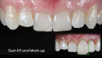 Before initiating treatment, it is important to establish final incisal edge positions based on any possible gingival margin changes and future width-to-height tooth proportions. Overly lengthening teeth can create narrow central incisors. Using digital techniques (eg, proportion boxes with defined width-to-height percentages) to pretreatment plan final incisal edge length prior to undertaking any gingival height changes is beneficial. The final incisor length can be previewed in a mock-up before preforming gingival lifts and ordering wax-ups to minimize chairtime for contouring provisional restorations. Concave smile restored to a more convex appearance with IPS Empress restorations.