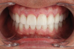Incisal embrasure loss creates an aged smile appearance. Preoperatively, a 38-year-old patient with attrition effects of bruxism exhibited evident incisal embrasure loss, which aged the smile. Pretreatment planning incorporated mock-ups and proportion guides to establish ideal length, and IPS e.max restorations were placed to recreate the incisal embrasures and maintain a masculine look; optimize strength, function, and esthetics; and create a youthful appearance.