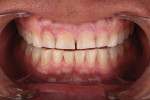 Incisal embrasure loss creates an aged smile appearance. Preoperatively, a 38-year-old patient with attrition effects of bruxism exhibited evident incisal embrasure loss, which aged the smile. Pretreatment planning incorporated mock-ups and proportion guides to establish ideal length, and IPS e.max restorations were placed to recreate the incisal embrasures and maintain a masculine look; optimize strength, function, and esthetics; and create a youthful appearance.