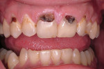 Figure 1  Class V caries due to ingestion of carbonated beverages.