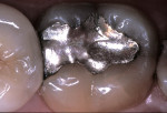 Figure 1  Preoperative occlusal view of a defective amalgam restoration on the mandibular left second molar with recurrent decay.