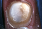Figure 2  Composite buildup and crown preparation was performed on the mandibular left second molar.