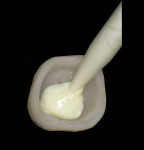 Figure 3  The provisional restoration was cemented with a self-cure zinc oxide non-eugenol cement.