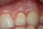 Figure 1a  Teenager with Class V caries/decalcification.