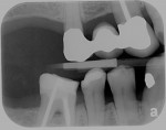 Fig 5. Initial radiographs showing dental condition and bone levels.