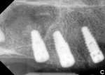 Fig 11. Post-surgery radiographs showing bilateral sinus “bumps.”