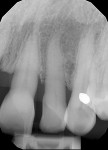 Fig 4. Initial radiographs showing dental condition and bone levels.
