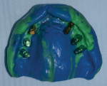 Fig 14. Implant-level open-tray final impression using a duplicate of the transitional denture as the custom tray with implant analogs.