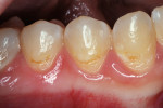 Figure 2a  Caries associated with poor oral