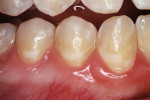 Figure 2b  he nano-ionomer’s shade was slightly lighter than the surrounding enamel, 10 months after restoration.