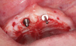 Fig 7. After placement of the implant in the right maxillary central incisor site, a SATURNO angled parallel pin was placed in the left central incisor site and adjusted.