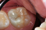 Figure 4a  A 6-year-old girl with a large intracoronal lesion in newly erupted permanent first molar.
