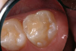 Figure 4e  Nano-ionomer at 13 months, resealed with a self-etching bonding agent and clear resin sealant.<sup>9</sup>