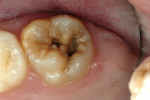 Figure 5a  Hypoplastic/caries lesion in a 10-year-old girl.