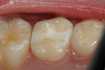 Figure 7a  A 9-year-old patient with intact mesioocclusodistal nano-ionomer primary molar restoration, 12 months after treatment.
