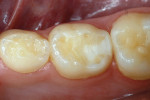 Figure 7b   Distoocclusal nano-ionomer repair of primary molar, also 12 months posttreatment.