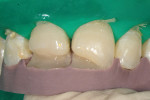 Figure 2  View of the lingual enamel compositelayer that was created with the matrix in place inthe mouth.