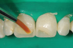 Figure 4  The dentin shade of composite—usually a shade darker—was applied as the firstdentin increment and spread over the toothsurface and the bevel with a brush.