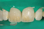 Figure 5  After a white-tinted resin (Kolor +, KerrCorporation) was applied to the incisal edge to createa halo, a high translucent composite was appliedto accentuate the translucency of the incisal third.