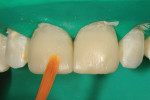 Figure 6  The facial enamel increment wassmoothed with a brush, with care taken to contourand blend the material toward the cervical andexcess toward the incisal.