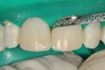 Figure 8  To finish contouring the proximalaspects of the restorations, flexible strips wereused to create a smooth appearance.