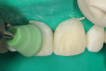 Figure 9  The anterior composite restorationswere polished using a three-step polishingprocess that included fine, medium, and coarsepolishing cups.