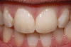 Lithium disilicate anterior veneers luted with a light-curing luting cement (Variolink Veneer, Ivoclar Vivadent, www.ivoclarvivadent.com). Ceramics by Gold Dust Dental Lab.