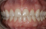 Fig 1. A preoperative photograph shows the wear on the maxillary incisors and lower anterior crowding.