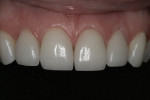 Fig 12. A close-up view of the completed porcelain veneers on teeth Nos. 7 through 10.