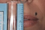 Fig 4. Central incisor display measured with the lips in repose.