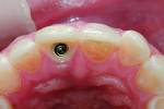 Fig 9. Incisal view showing implant position and contours of the provisional restoration. Screw access was slightly buccal in case a traditional screw-retained crown was to be designed.