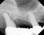 Figure 1  Pretreatment radiograph shows a failingfixed partial denture from tooth No. 2 to toothNo. 4 with a cantilever at site No. 5.