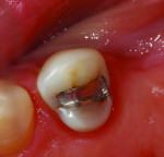 Figure 1. A failing conservative amalgam restoration. Cusps are not undermined and sufficient tooth structure remains to restore this tooth predictably with a composite resin restoration.