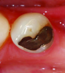 Figure 2. Upon removal of the restoration, the lingual, distal, and mesial walls will be completely undermined. A composite resin restoration will not adequately support the tooth structure, and a restoration such as a bonded ceramic onlay would more ideally support the tooth while replacing missing structure. In this case, full coverage may not be warranted due to ample and sound buccal tooth structure.
