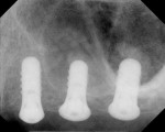 Figure 3  The postoperative radiograph showsStraumann implants (Straumann USA LLC,Andover,MA) measuring 4.1 mm x 10 mm at site No. 12,4.1 mm x 8 mm at site No. 13, and 4.8 mm x 8mm at site No. 14. OMSFE attained 3 mm to 5 mmof height at site Nos. 13